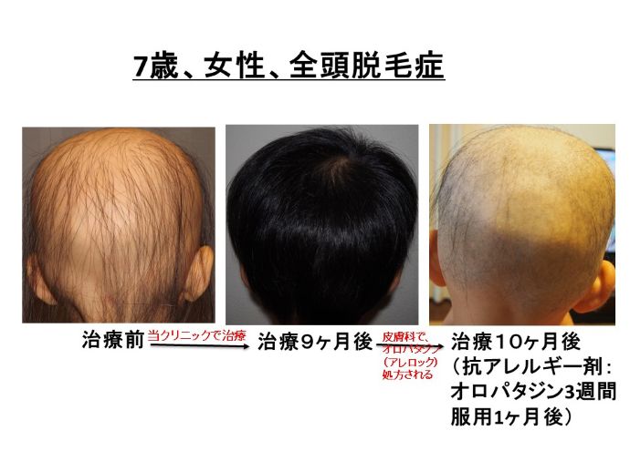 円形脱毛症　病院